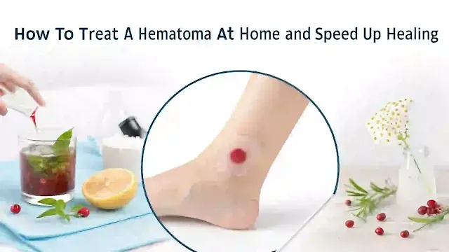 How to Treat a Hematoma at Home and Speed Up Healing